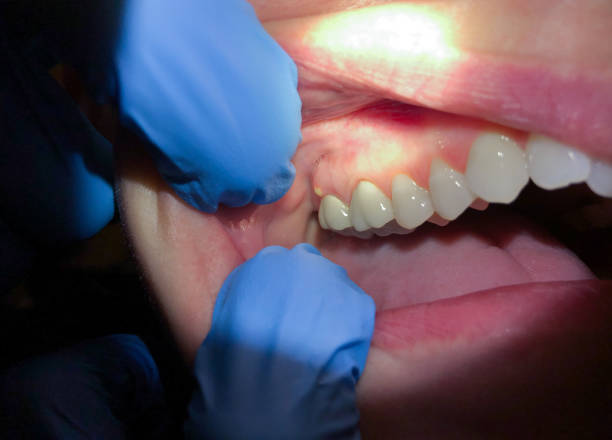 Best Emergency Dental Care for Broken or Chipped Teeth in Oakhurst, OK